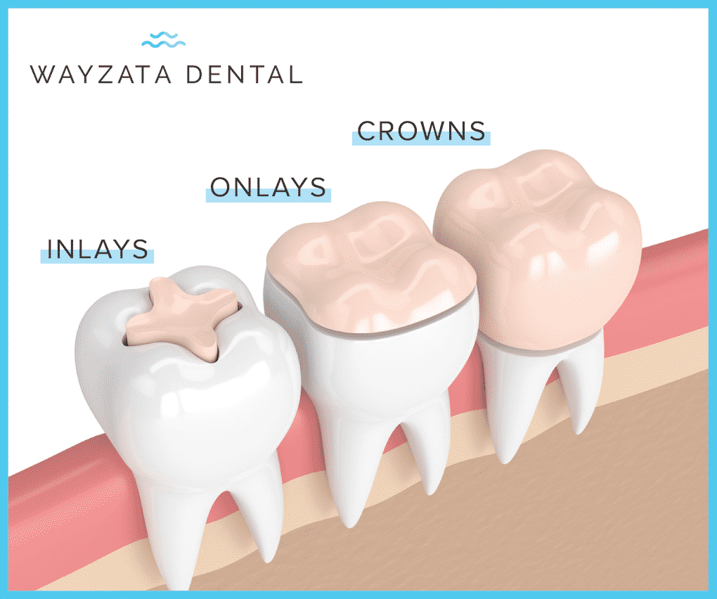dental inlays vs. onlays